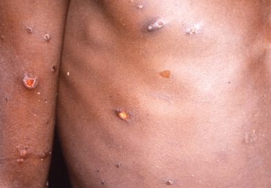 O vírus Monkeypox não sofreu mutação, pode estar contido em países não endêmicos: OMS |  Noticias do mundo
