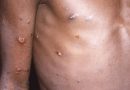 Surto de varíola ‘deflagrada por sexo em raves na Espanha e na Bélgica’